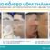 Trị Sẹo Ở Dr. Choice Clinic: Tất Cả Những Gì Bạn Cần Biết