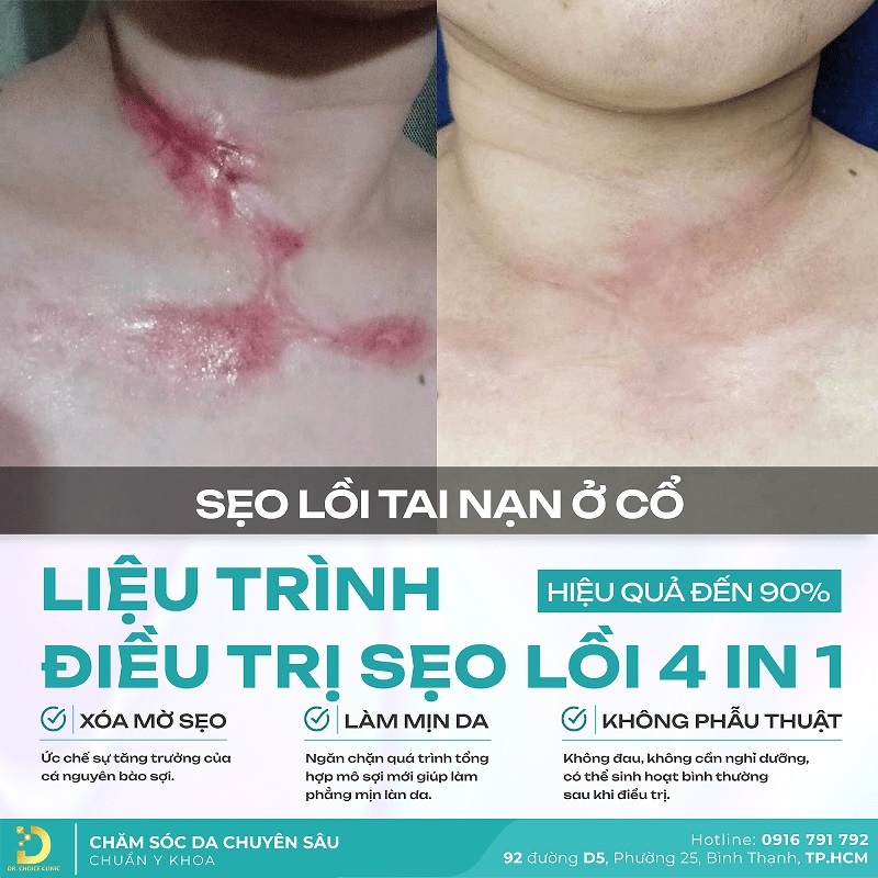 Trị Sẹo Lồi Tại Dr. Choice: Ưu Điểm và Báo Giá 1 tri seo loi o co