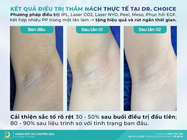 Liệu trình trị thâm nách/ bẹn an toàn tại Dr. Choice Clinic