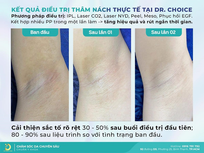Liệu trình trị thâm nách/ bẹn an toàn tại Dr. Choice Clinic 1 Liệu trình trị thâm nách/ bẹn tại Dr. Choice Clinic